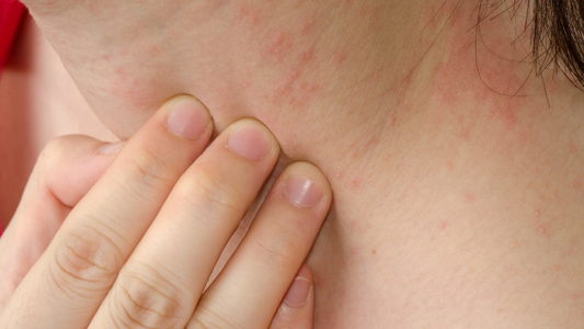 Natural Eczema Relief with Ice Plant Remedies