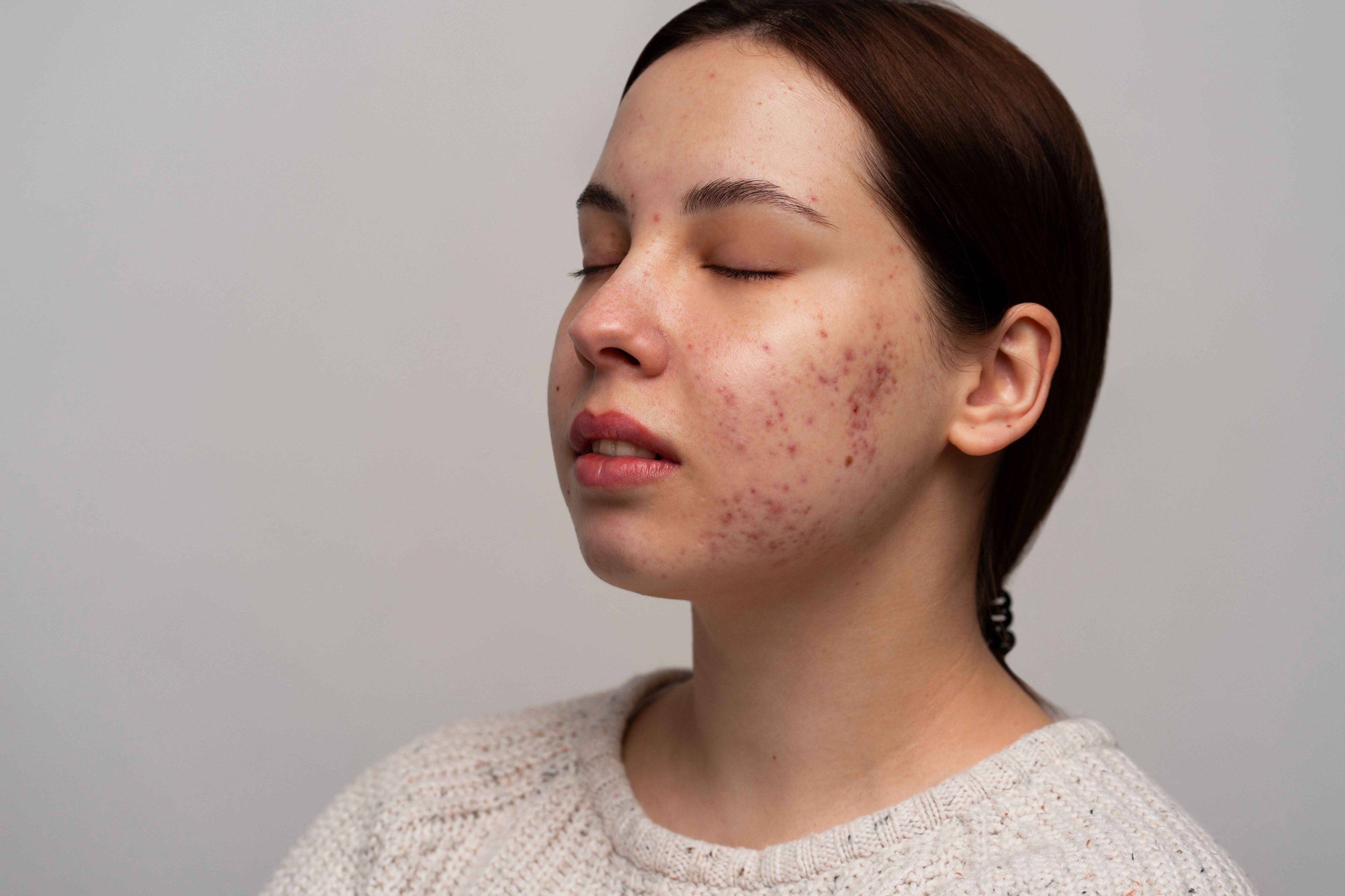 Hormonal vs. Bacterial Acne: Guide to Differentiating and Treating