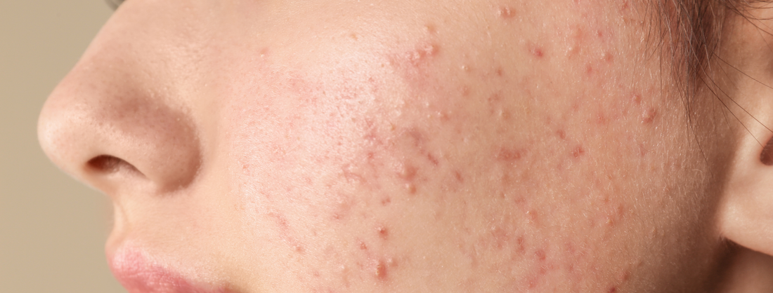 How To Treat Acnes & Pimples Naturally