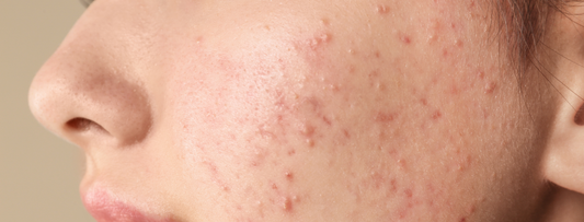 How To Treat Acnes & Pimples Naturally